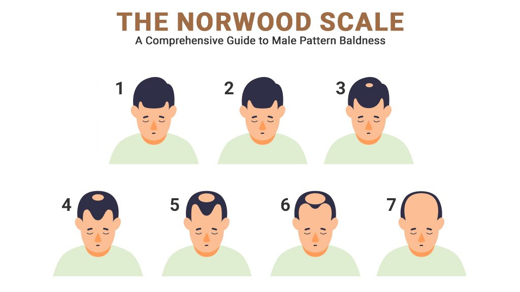 Hair loss progression stages