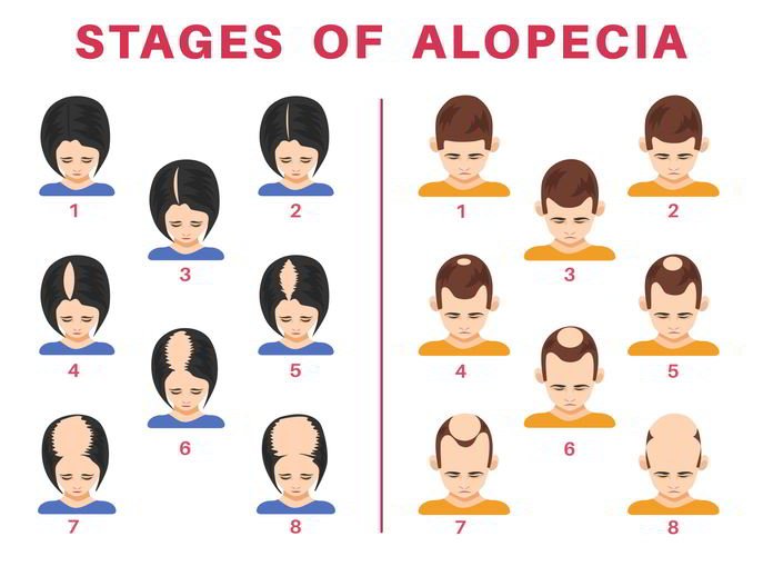Hair loss stages chart